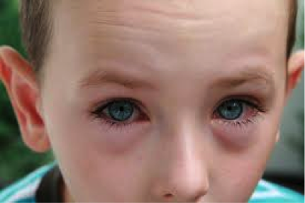 Close-up of a child's eyes showing dark circles and redness.